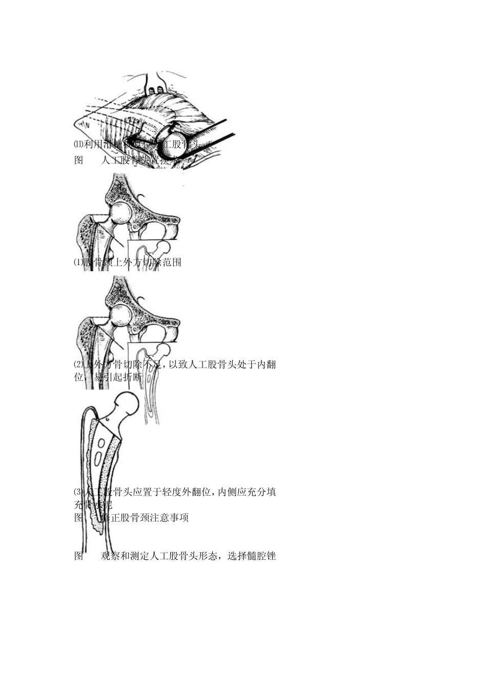 人工股骨头置换术_第3页
