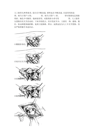 人工股骨头置换术