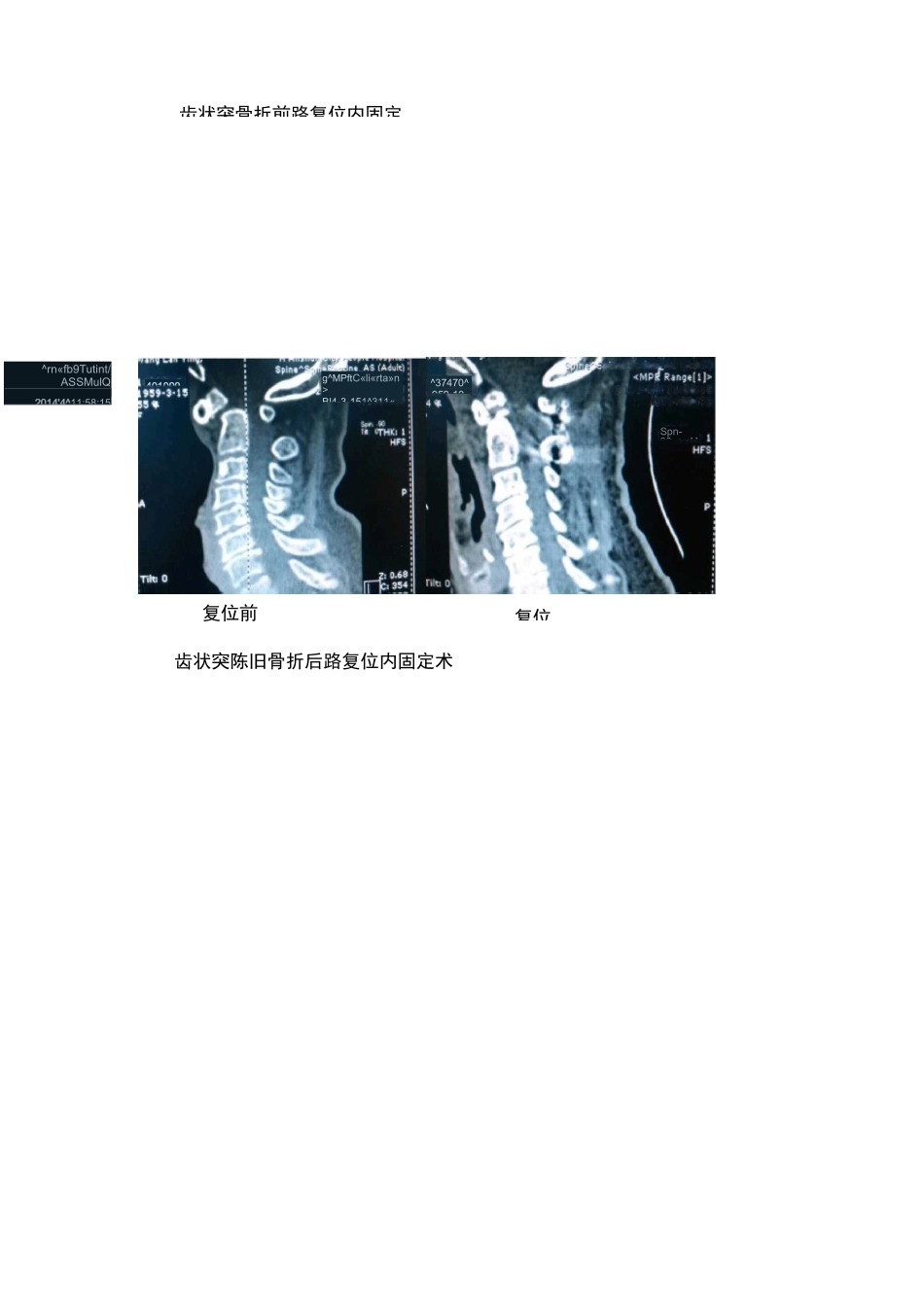 脊柱外科发展现状_第3页