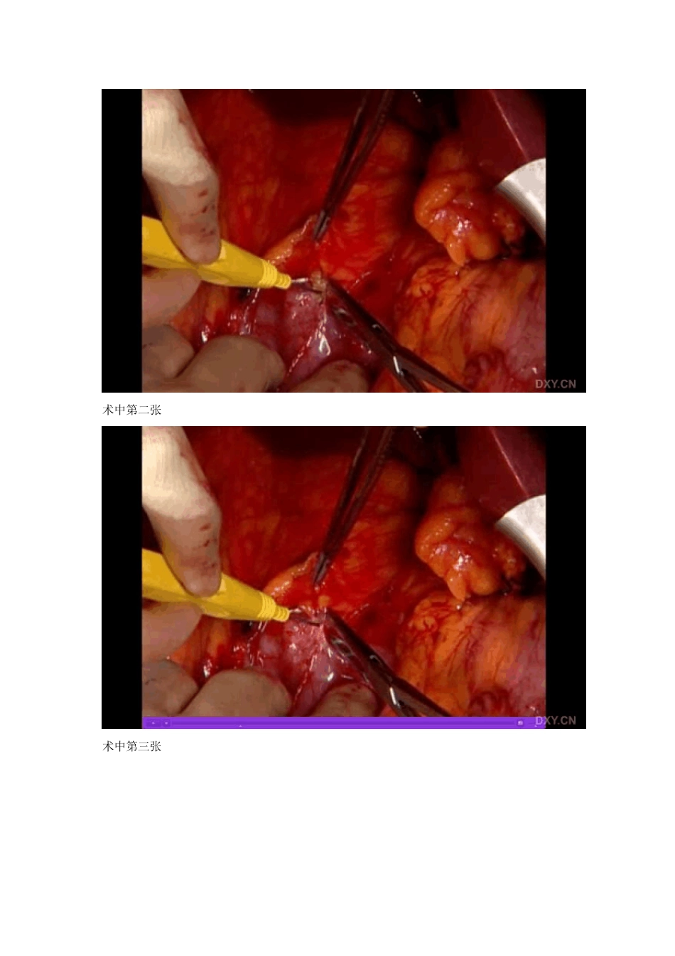 什么是KOCHER切口_第2页