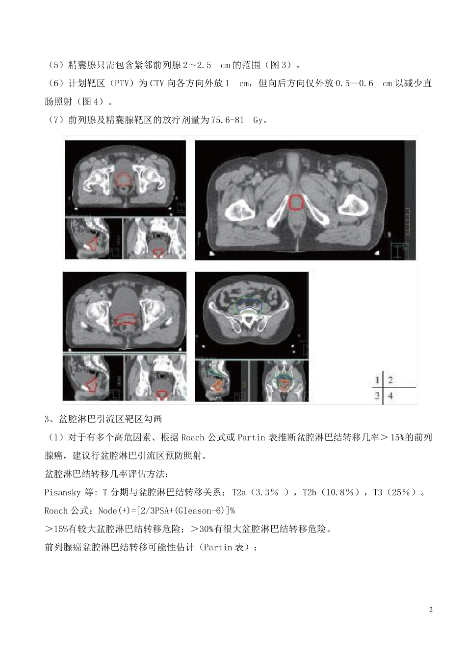 前列腺癌根治性放疗靶区_第2页