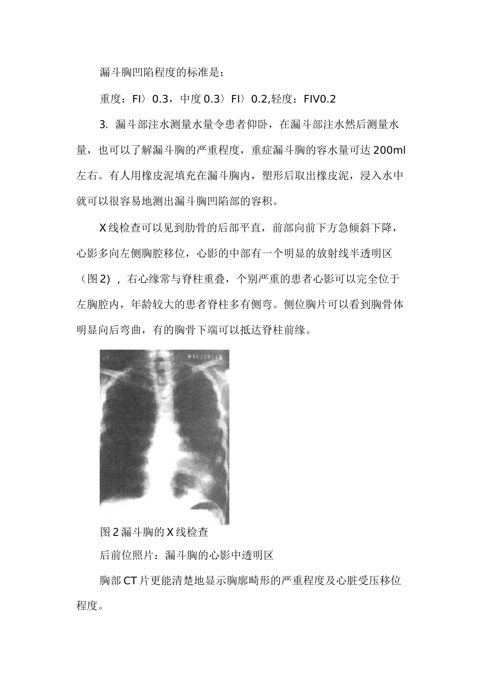 漏斗胸相关知识_第2页