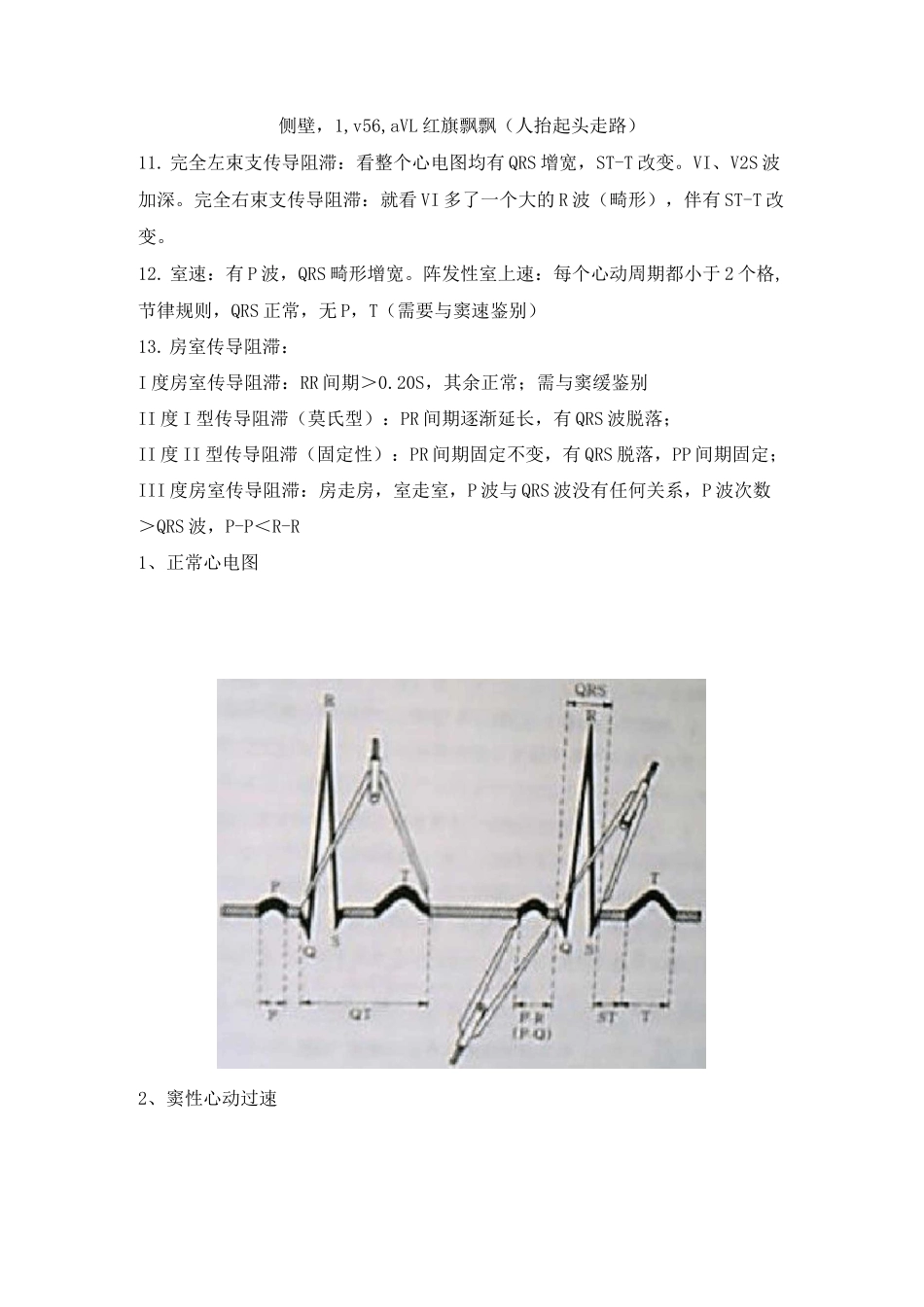 (完整版)典型心电图讲解_第2页