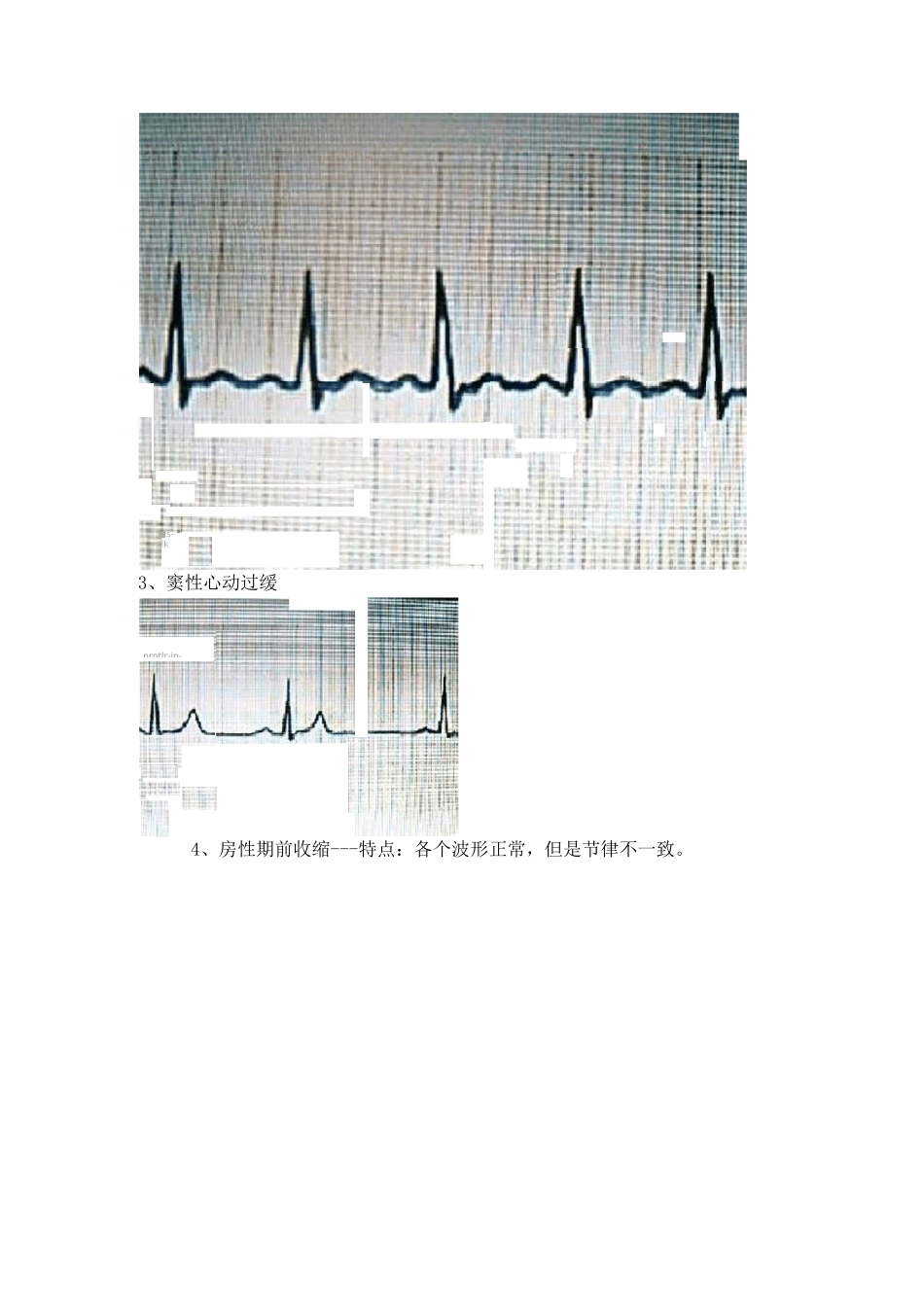 (完整版)典型心电图讲解_第3页