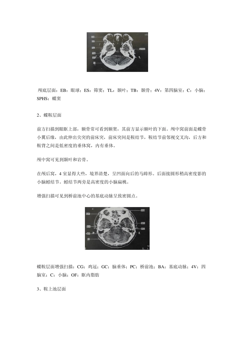 头颅CT及MRI_第2页