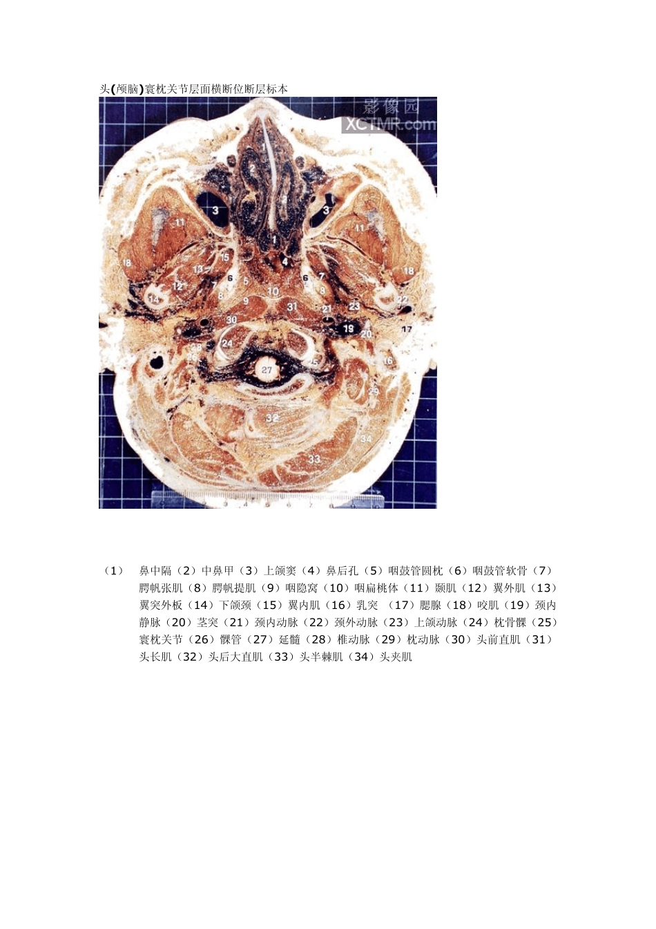 头颅横切面断层解剖_第3页