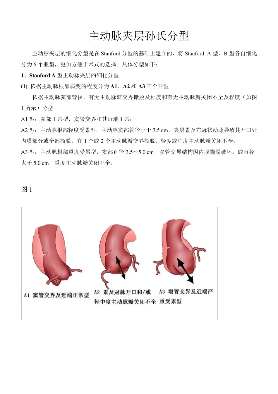 夹层分型及治疗方式_第1页