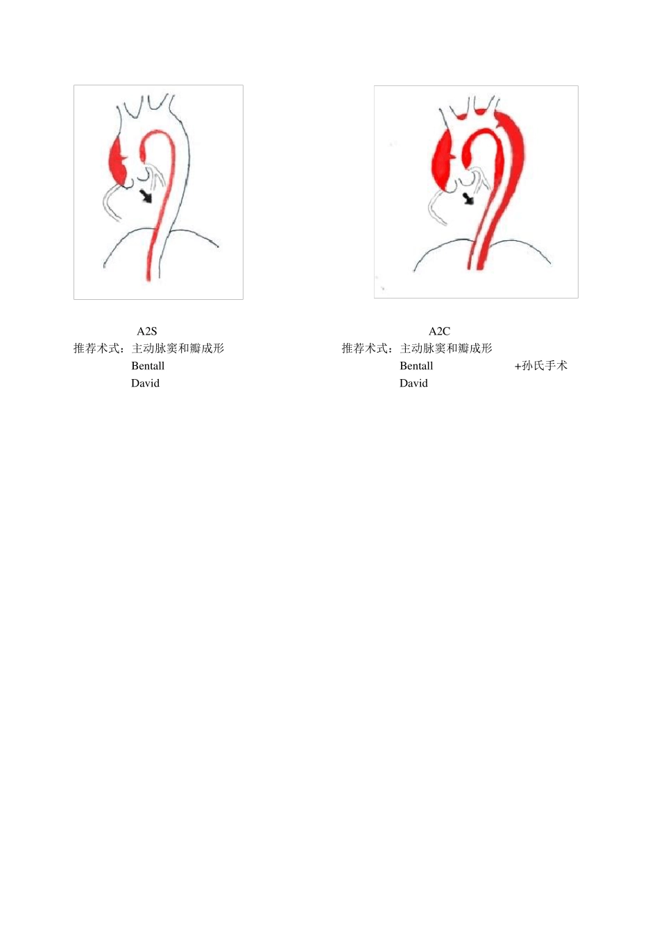夹层分型及治疗方式_第3页