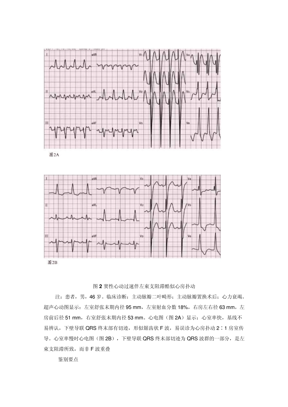 如何通过心电图“揪出”心房扑动？_第2页