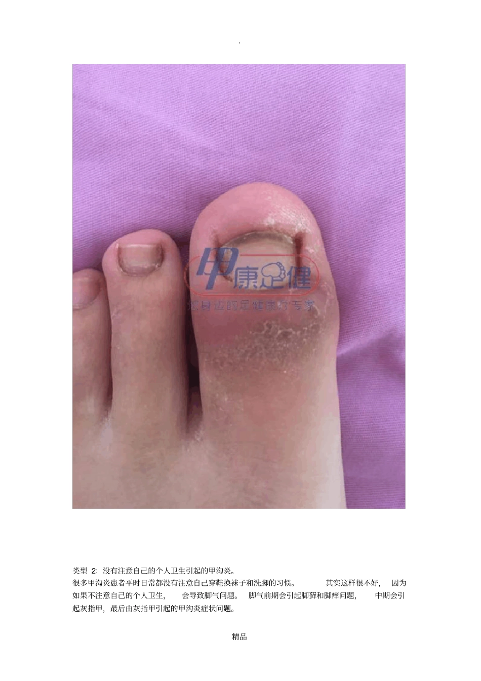 甲沟炎的治疗方法与效果对比_第2页