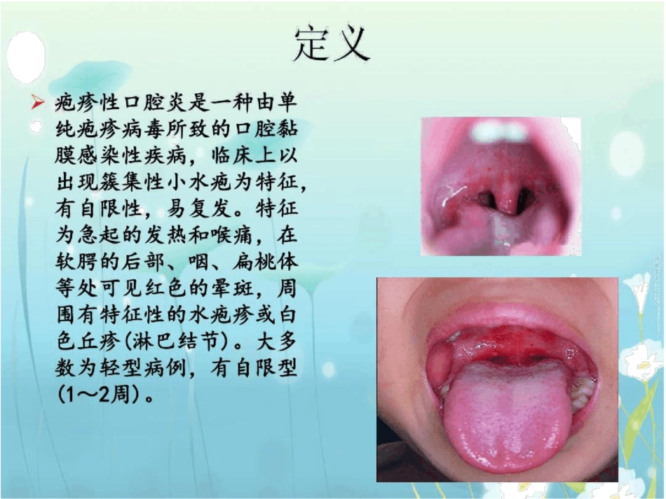 疱疹性咽峡炎_第2页