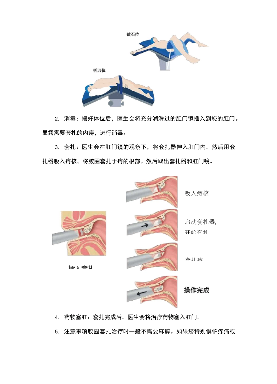 痔疮治疗胶圈套扎疗法健康宣教_第3页