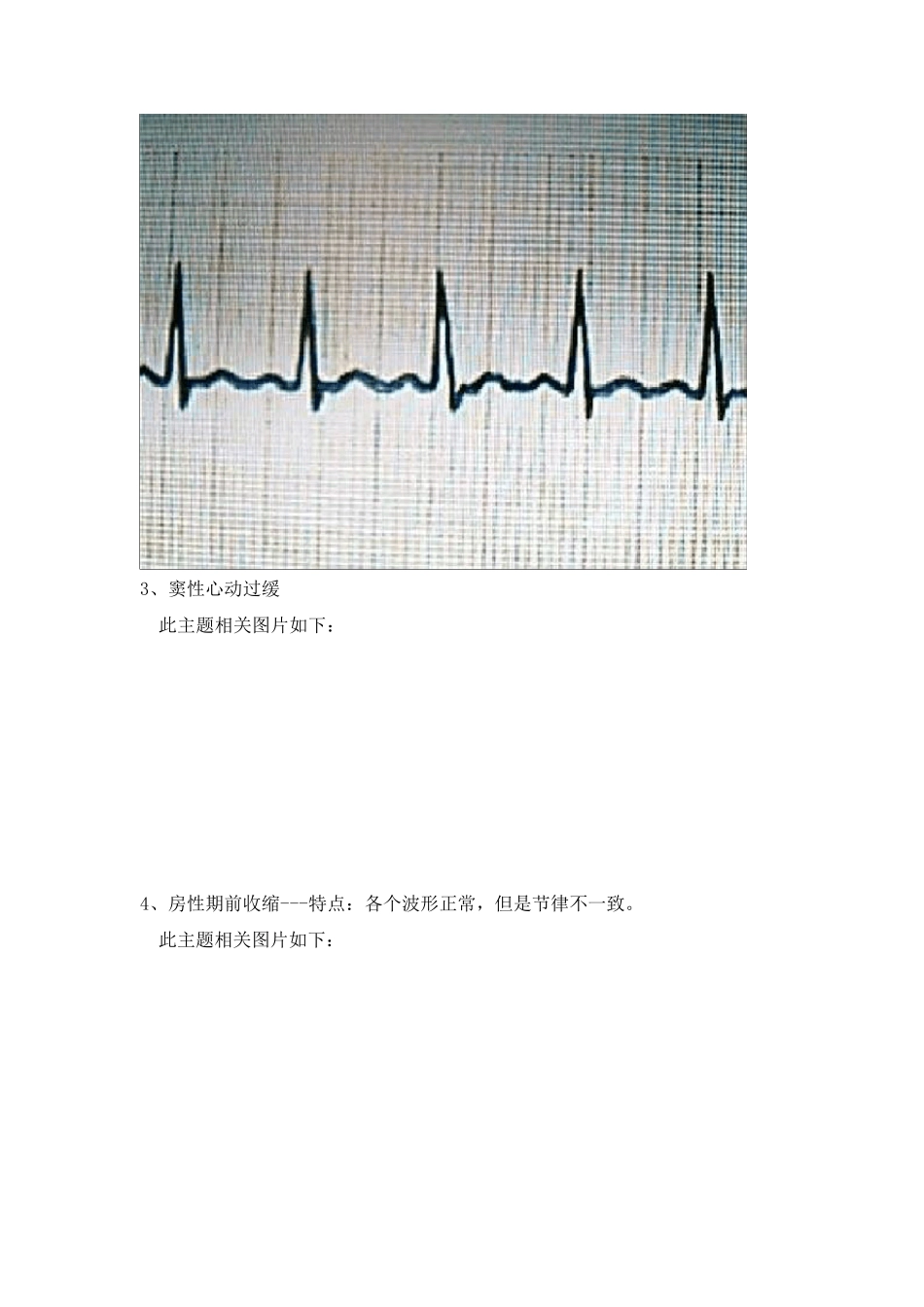 学习心电图必看讲解15例快速判断心电图技巧_第3页