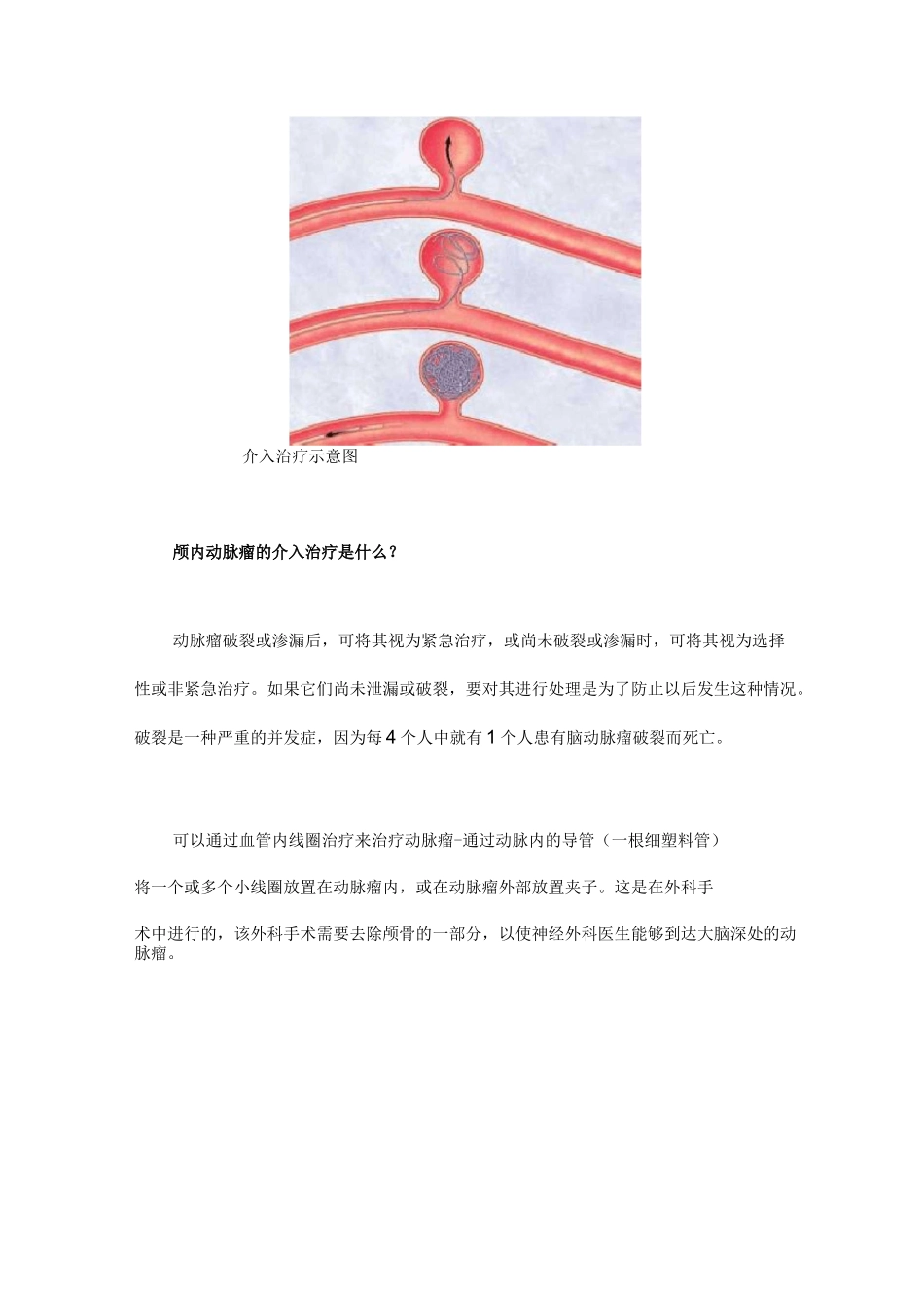 脑动脉瘤介入手术_第2页