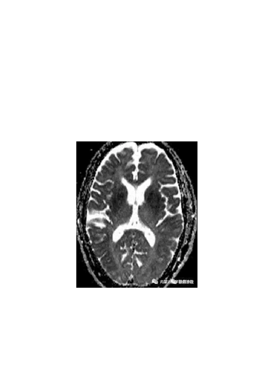 低血糖脑病的MRI表现及鉴别_第3页