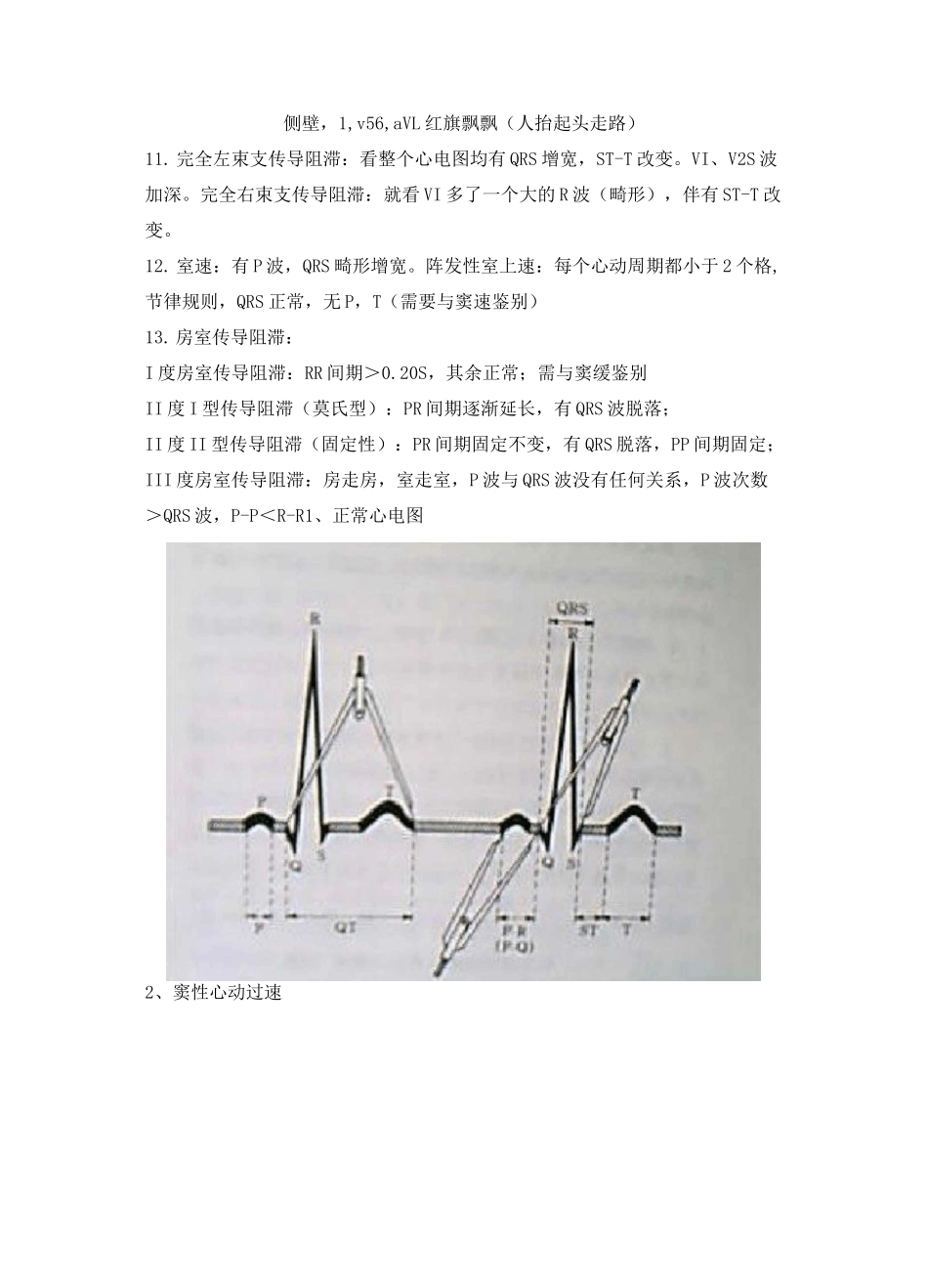 典型心电图讲解_第2页