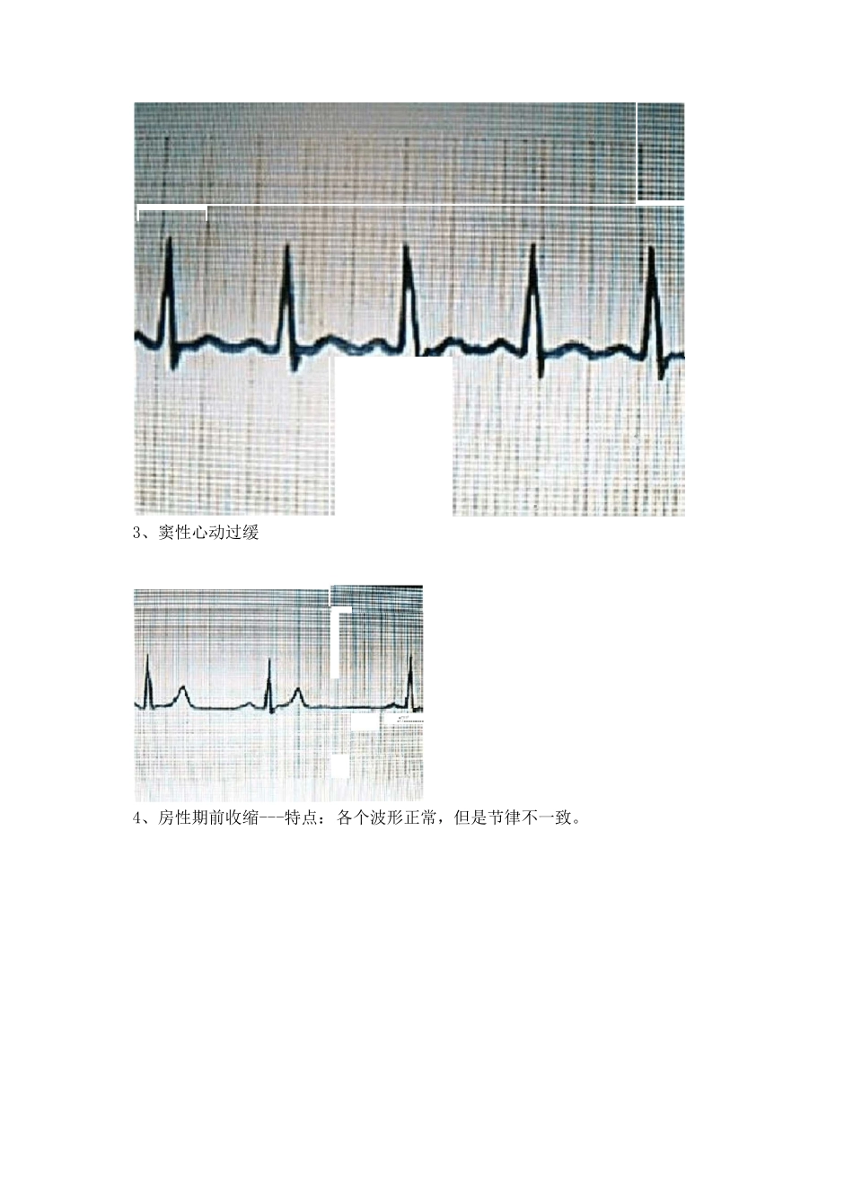 典型心电图讲解_第3页
