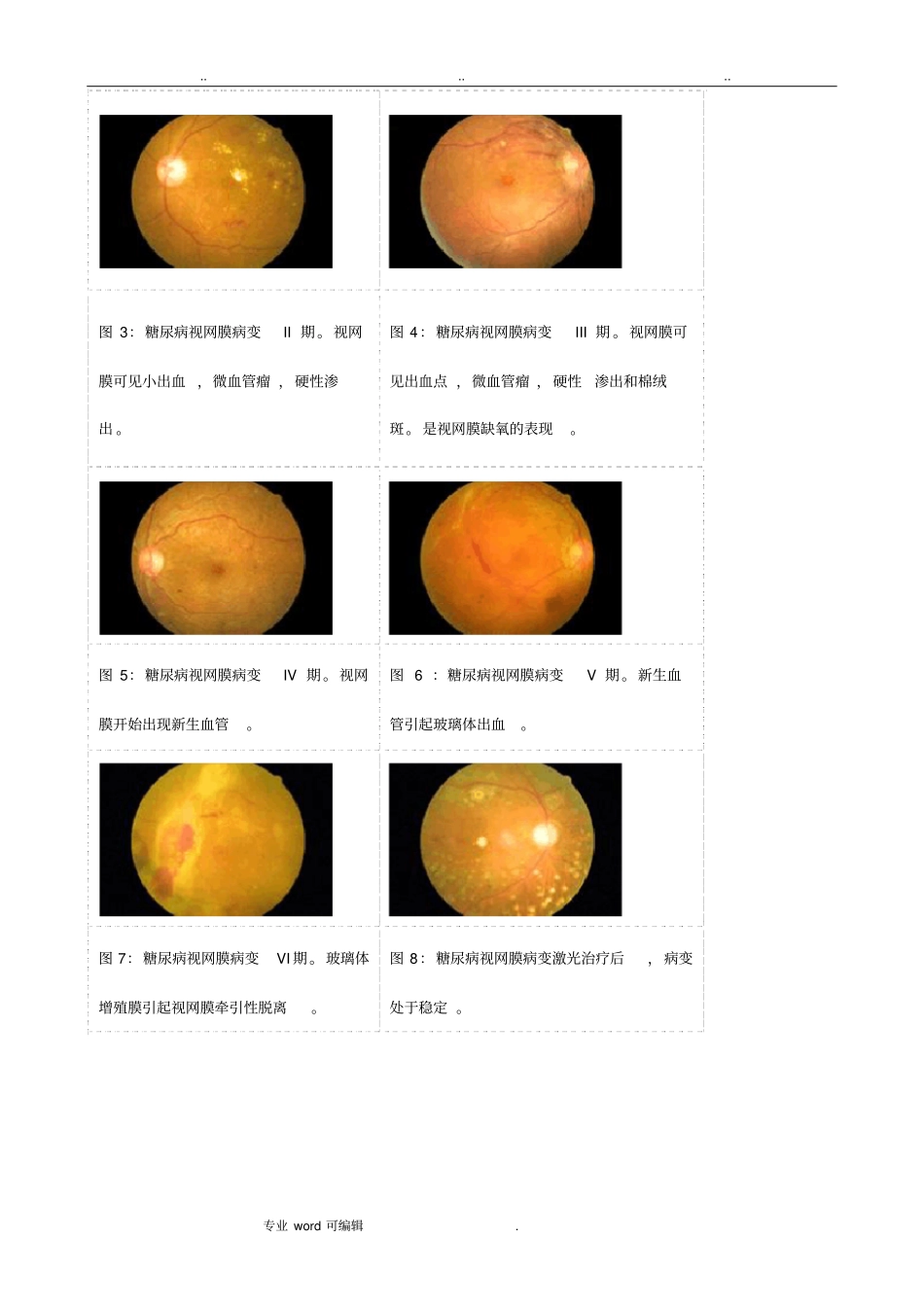 糖尿病眼底分期表现_第2页