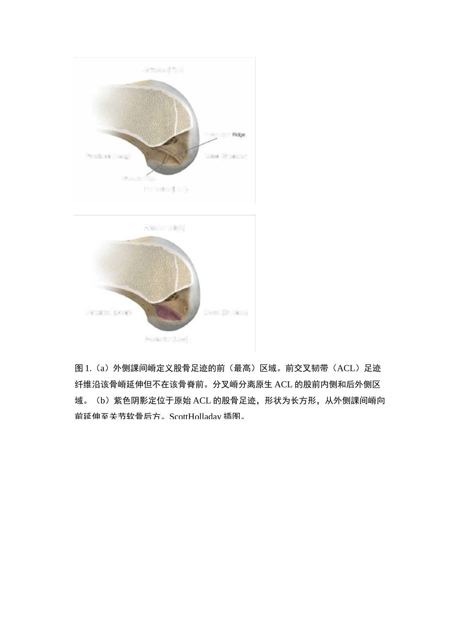 前交叉韧带重建植入位置最重要的五点基本理论：I.D.E.A.L股骨隧道定位_第3页