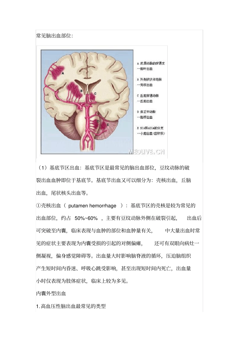 脑出血常见部位_第3页