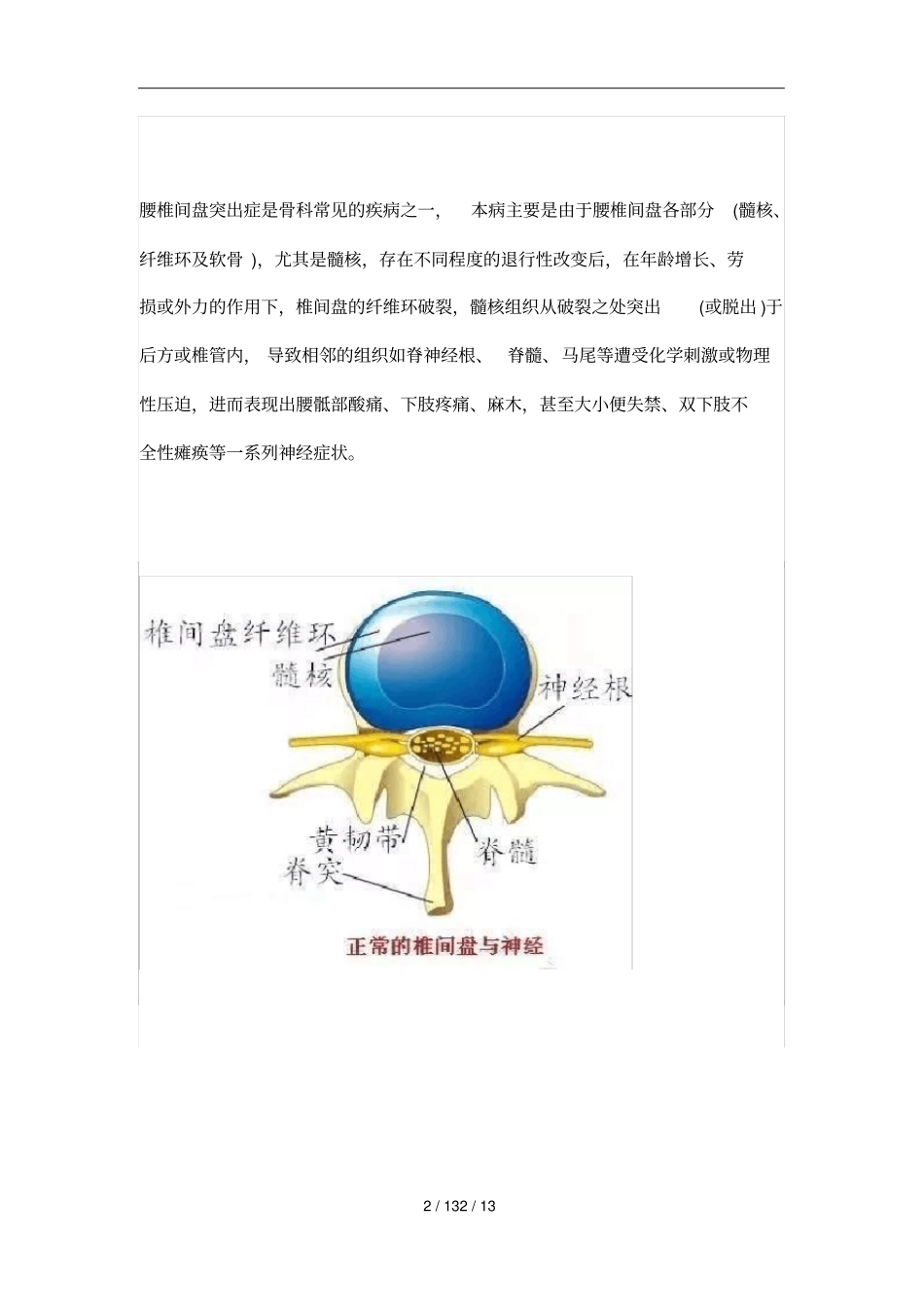 腰椎间盘突出知识大全_第2页