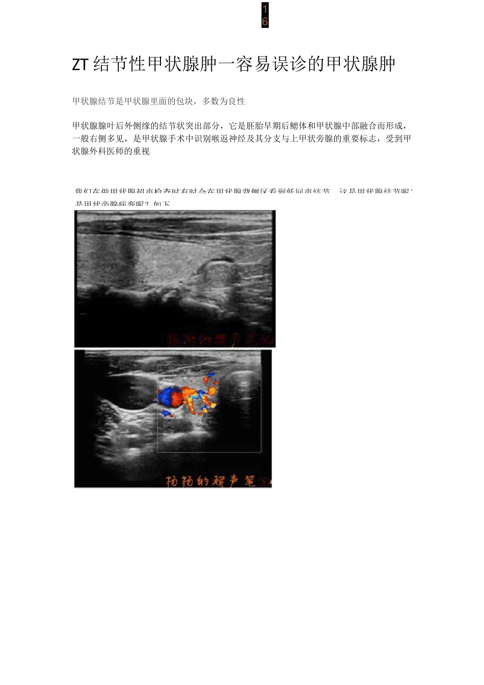 ZT结节性甲状腺肿-超声图文_第1页