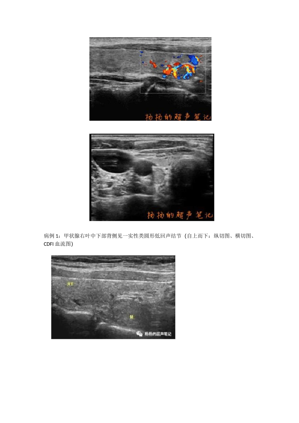 ZT结节性甲状腺肿-超声图文_第2页