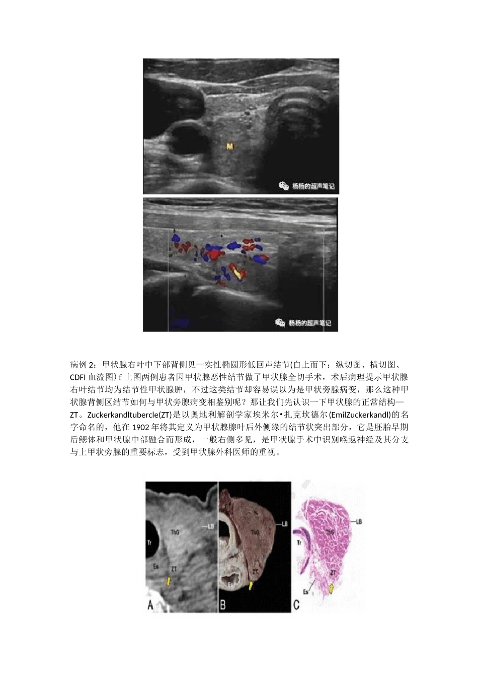 ZT结节性甲状腺肿-超声图文_第3页