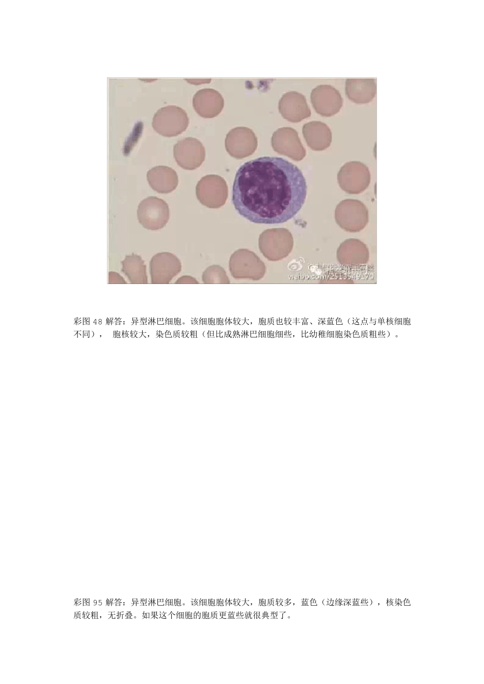 异型淋巴细胞的鉴定与区别_第2页