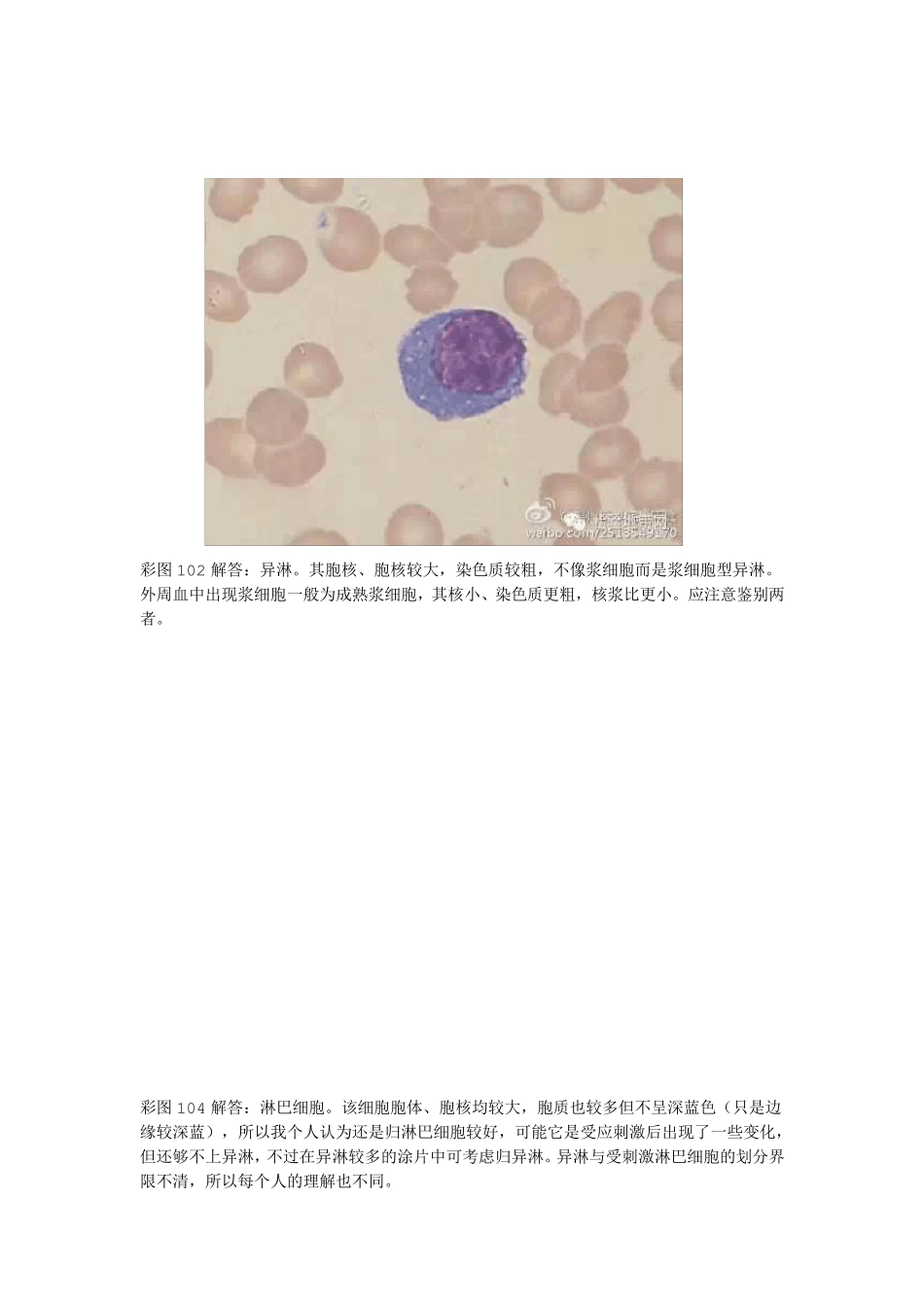 异型淋巴细胞的鉴定与区别_第3页