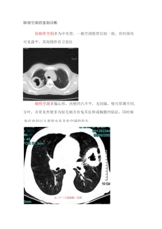 肺部空洞的鉴别诊断..