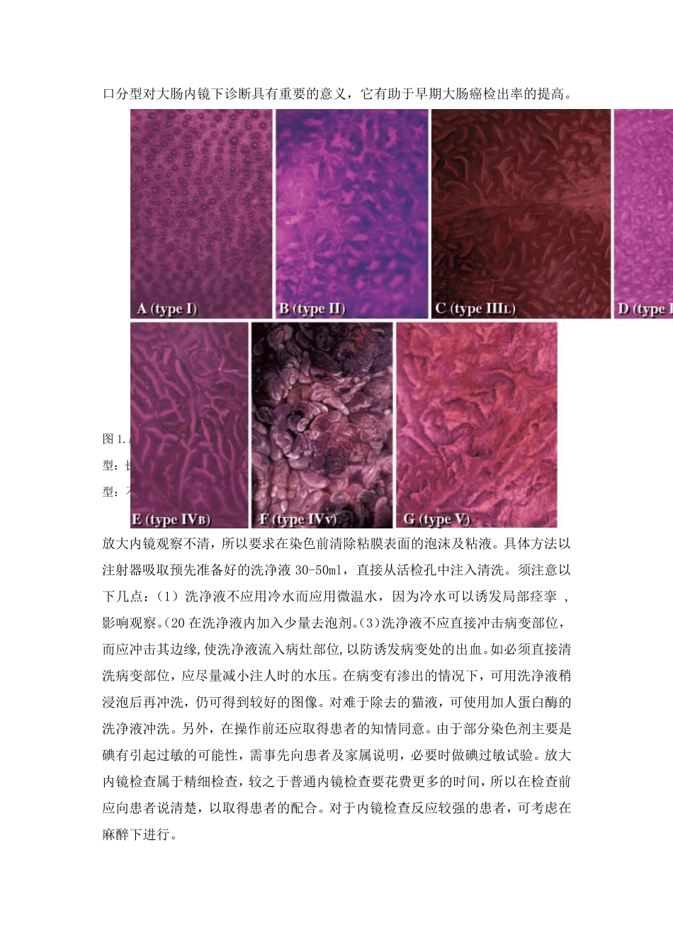 早期大肠癌的内镜诊断_第3页