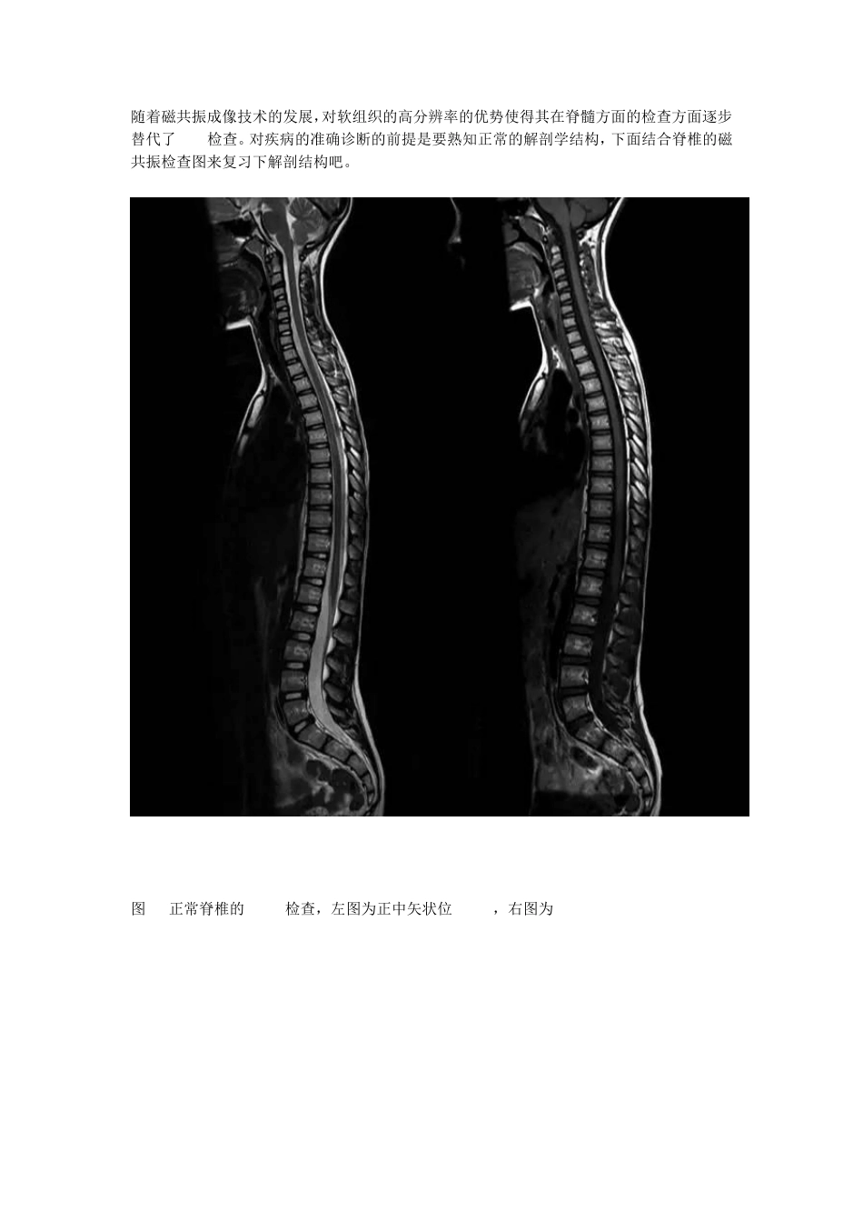 最全面的胸、腰椎MRI解剖_第1页