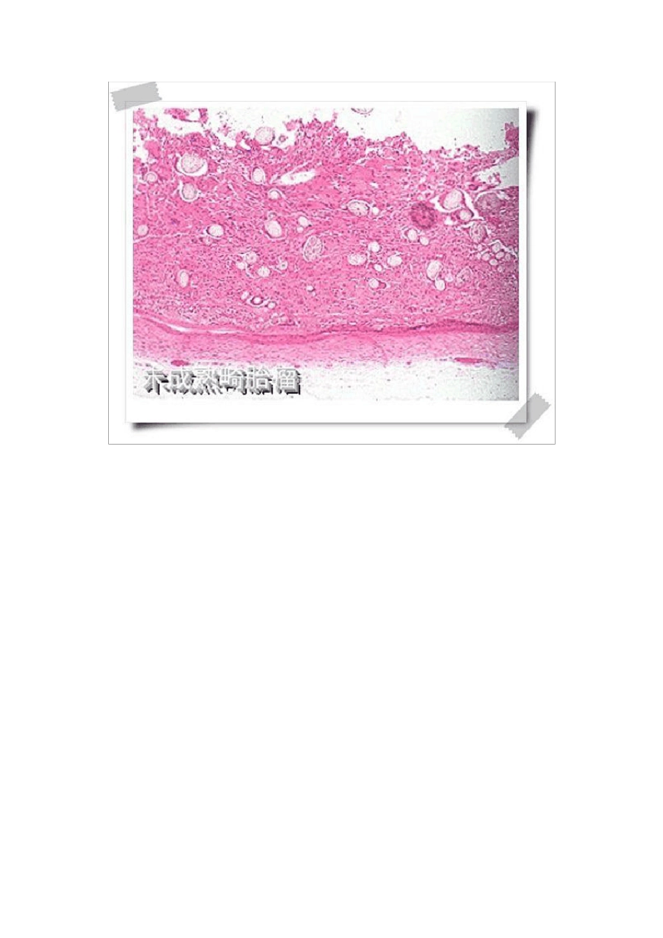 未成熟畸胎瘤_第3页