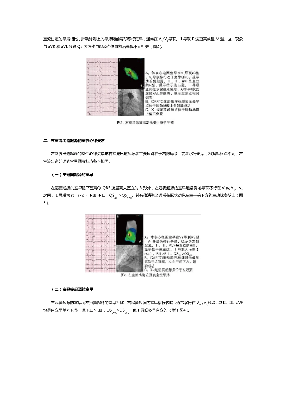 流出道室性早搏的体表心电图定位_第2页