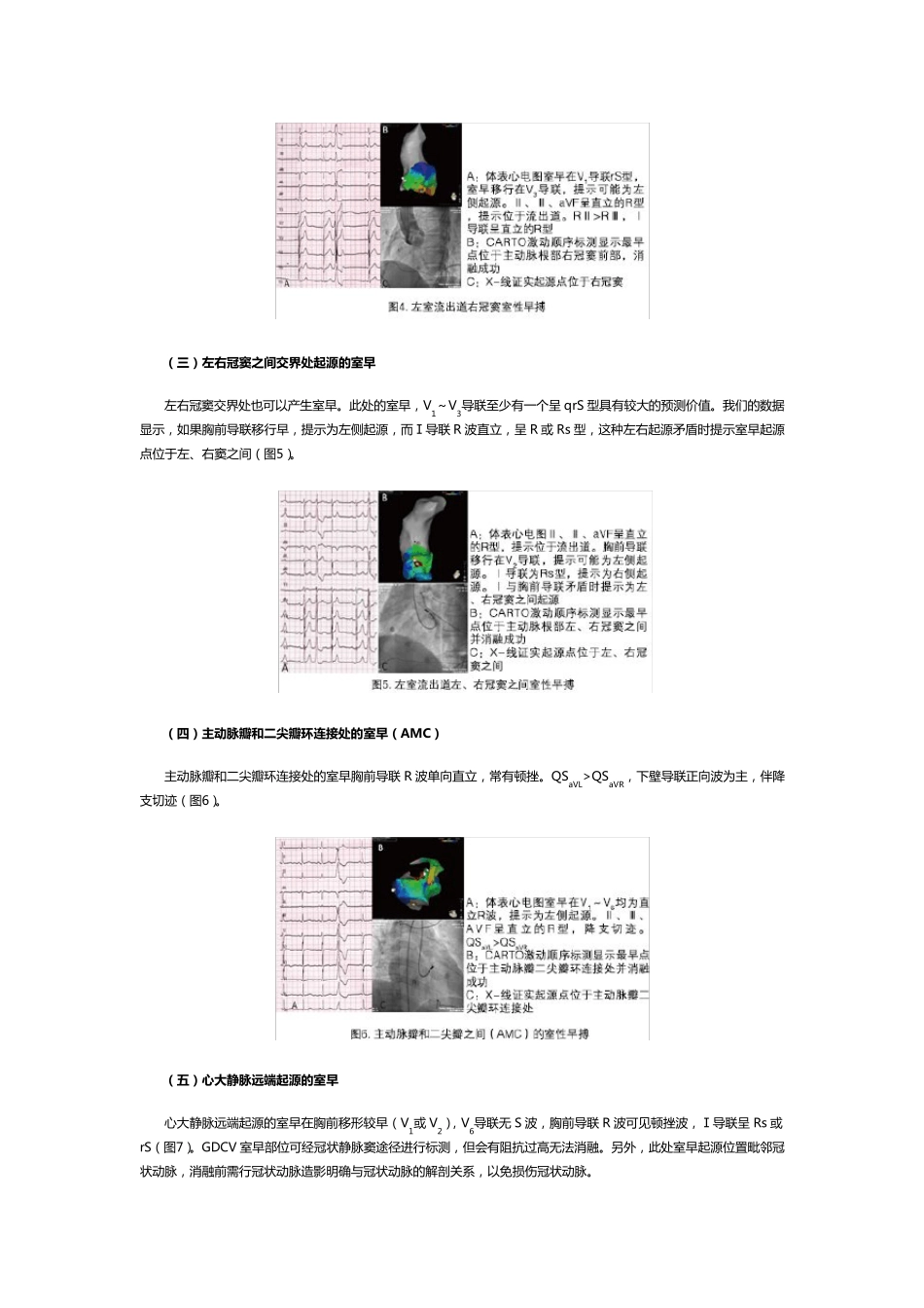 流出道室性早搏的体表心电图定位_第3页