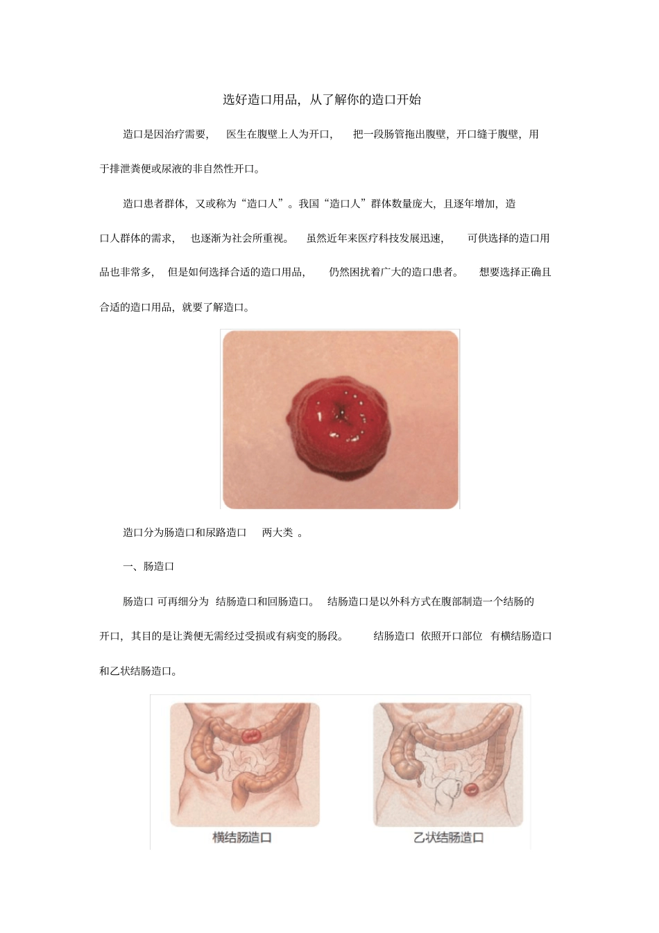 选好造口用品,从了解你的造口开始_第1页