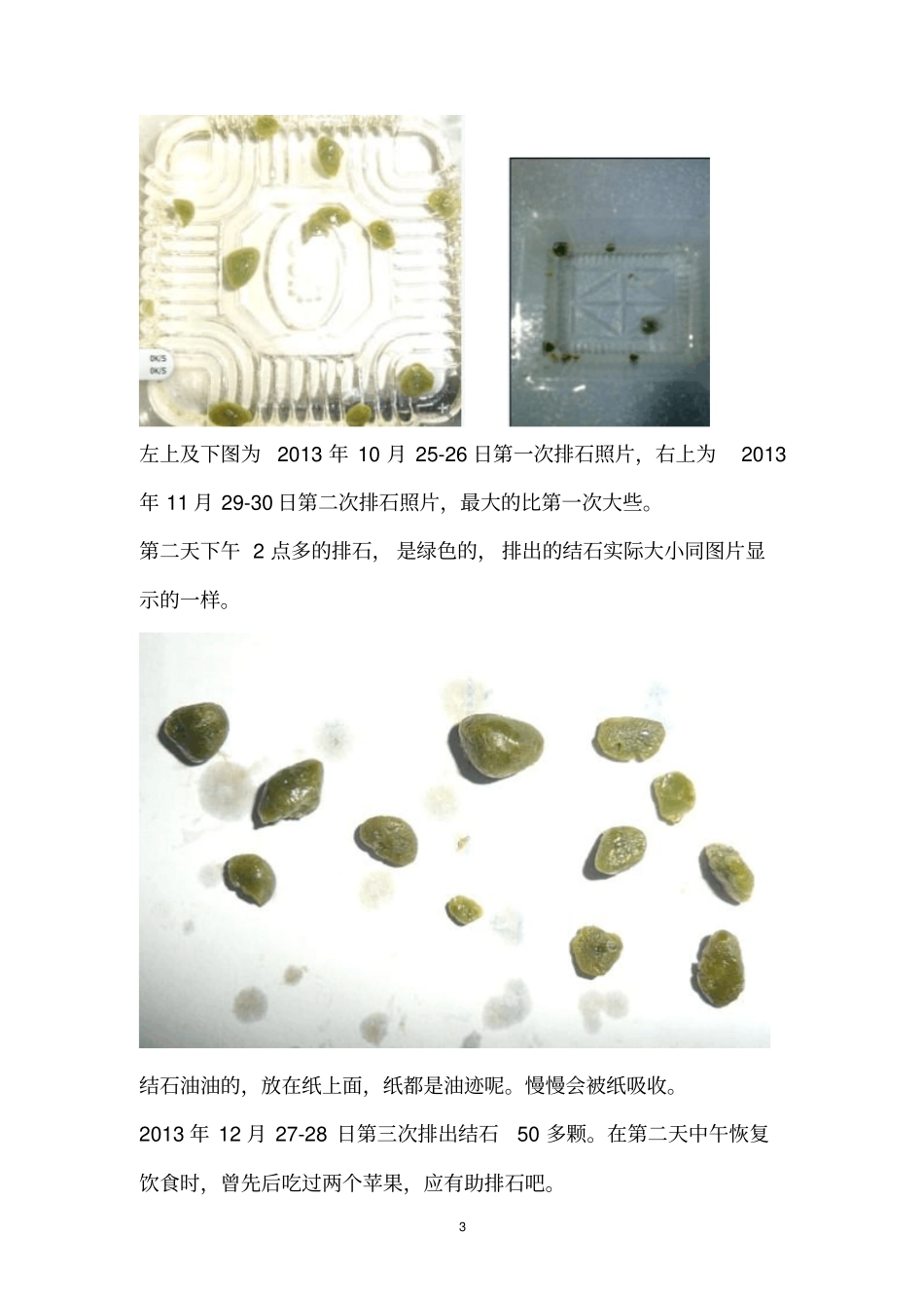 酵素配合植物油水果汁排石法、苹果汁排石法及排肾结石法等总汇_第3页