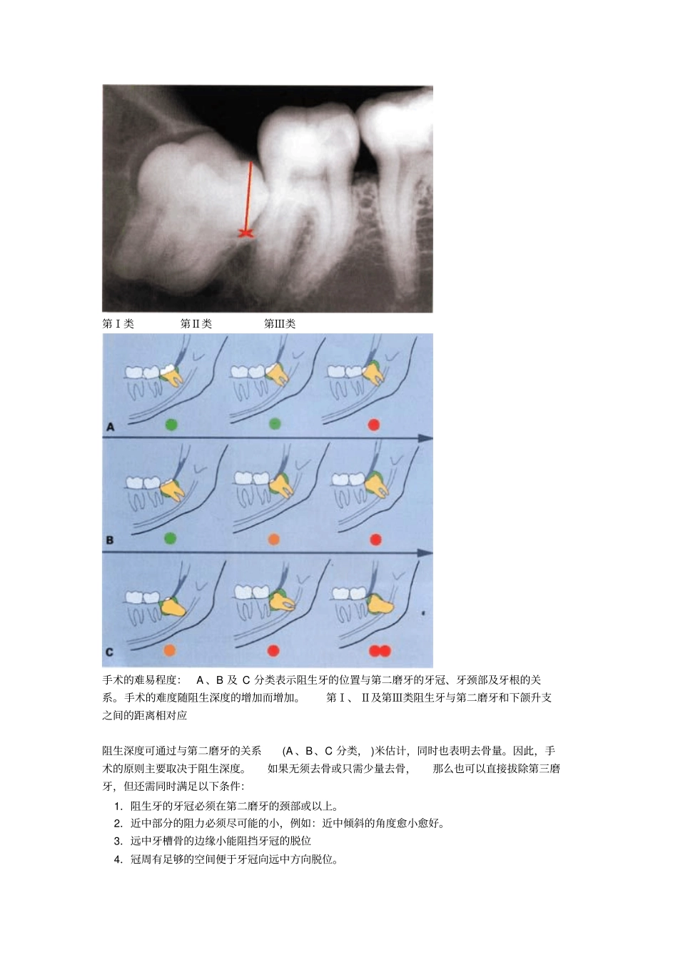 阻生第三磨牙拔除讲解_第2页