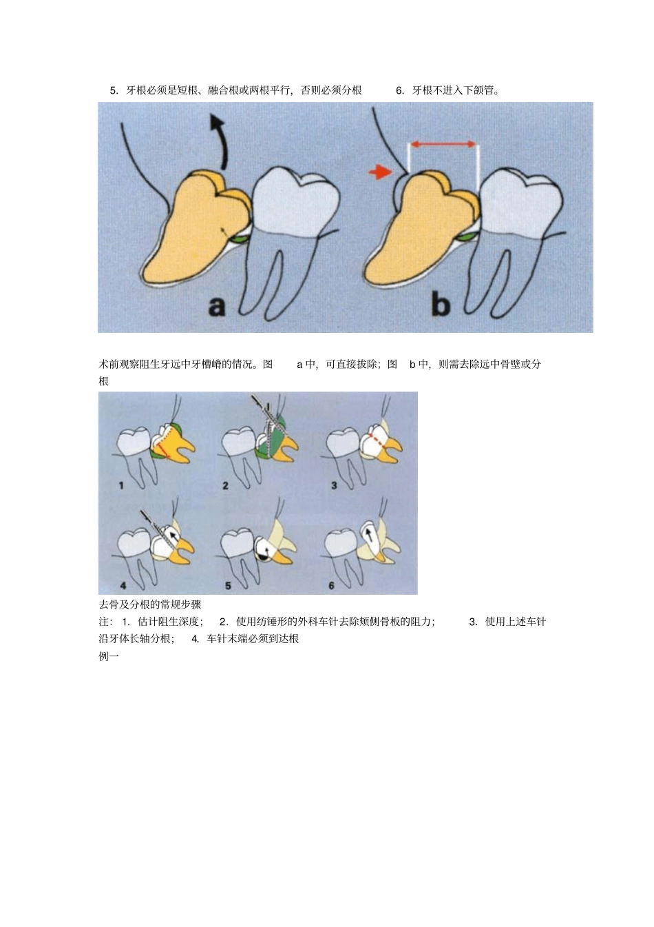 阻生第三磨牙拔除讲解_第3页
