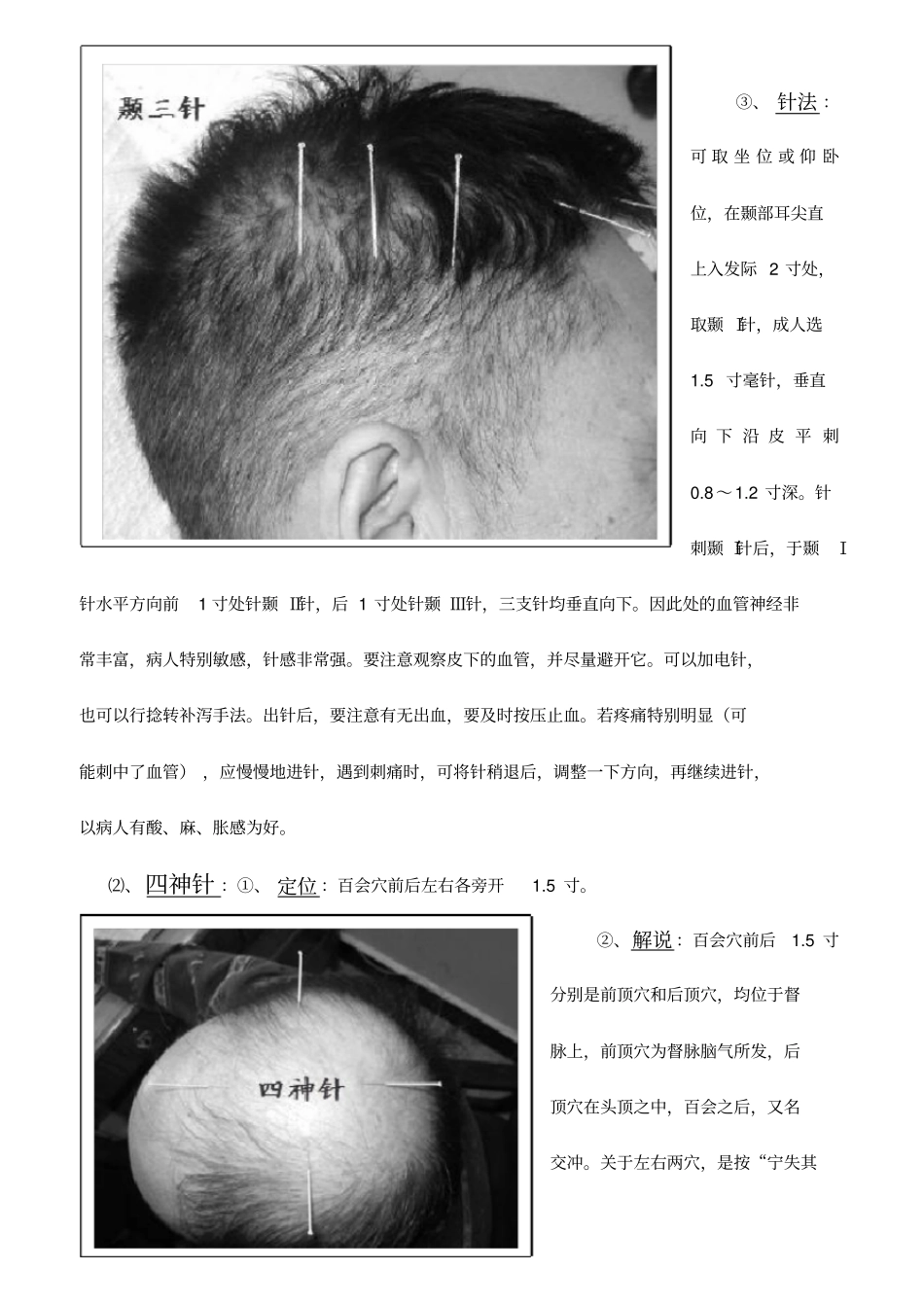 靳三针及张显臣之手三针、足三针汇总_第3页