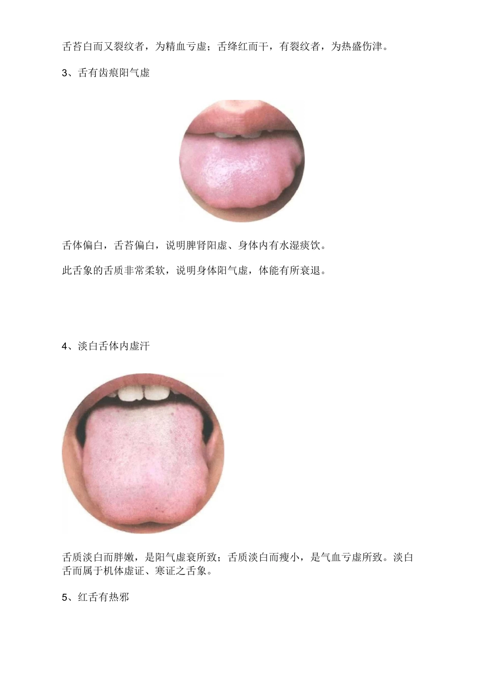 舌诊常见的舌苔舌形附高清图片典型舌象辩证_第2页