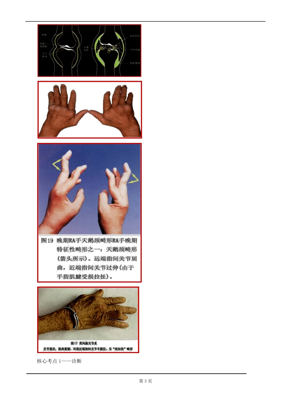 2017年执业医师考试重点-风湿免疫性疾病汇总_第3页