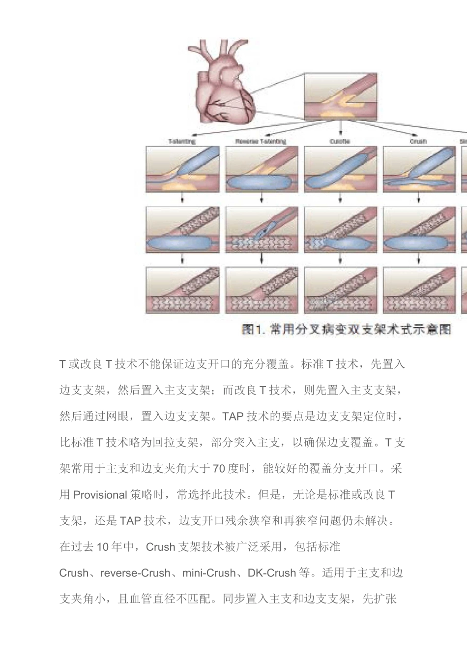 冠脉分叉病变支架术式精选文档_第3页