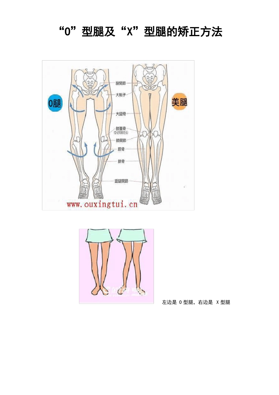 O型腿和X型腿的矫正方法_第1页
