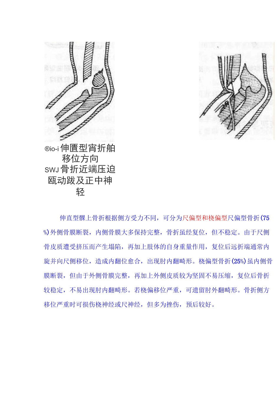 肱骨髁上骨折分型_第2页