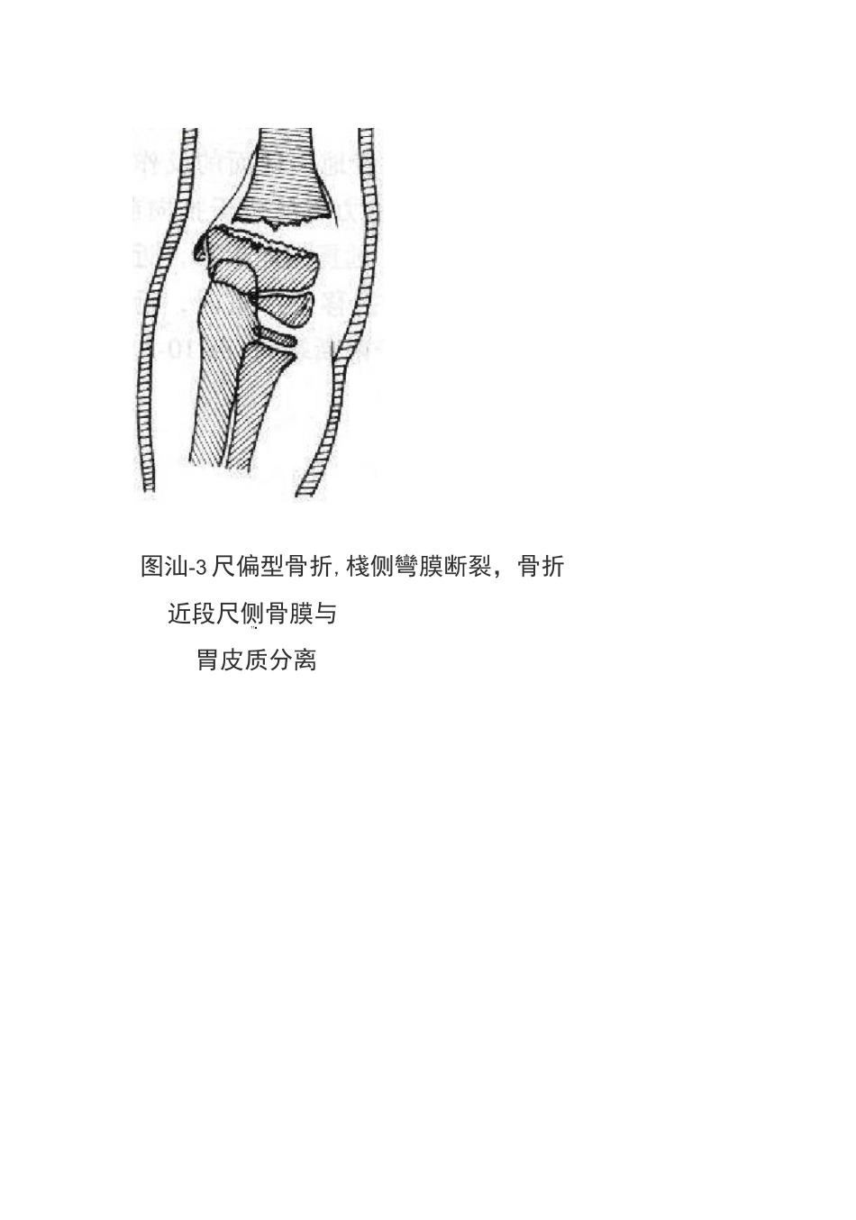 肱骨髁上骨折分型_第3页