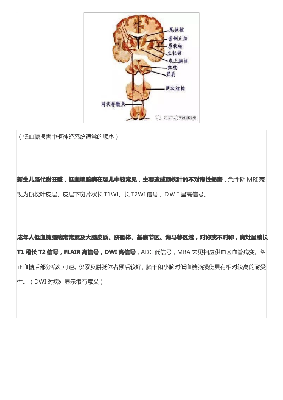 低血糖脑病的MRI表现及鉴别_第2页