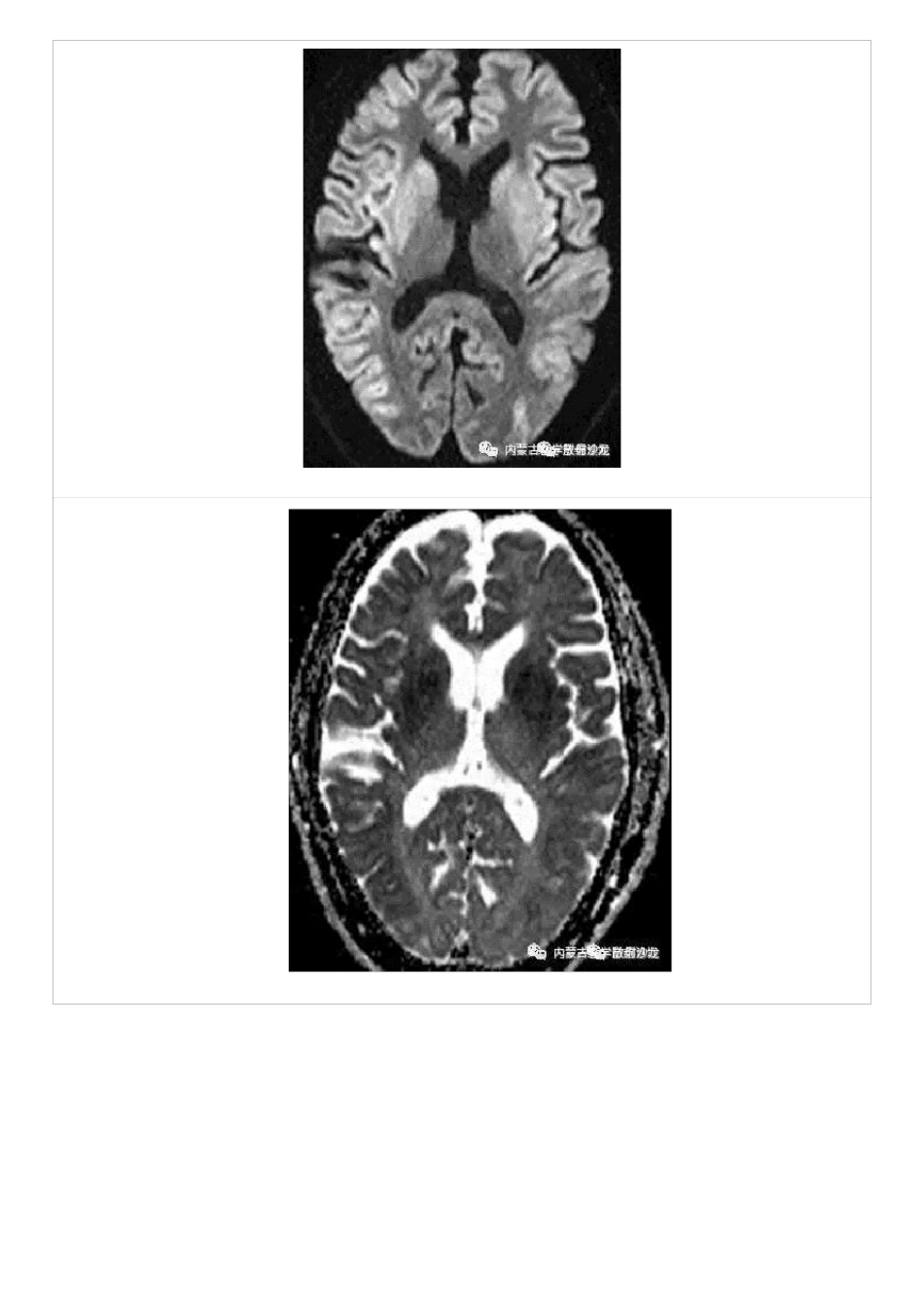 低血糖脑病的MRI表现及鉴别_第3页