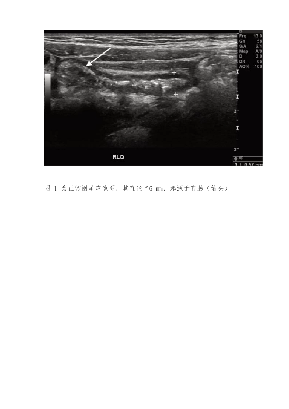 儿童腹痛超声诊断_第2页